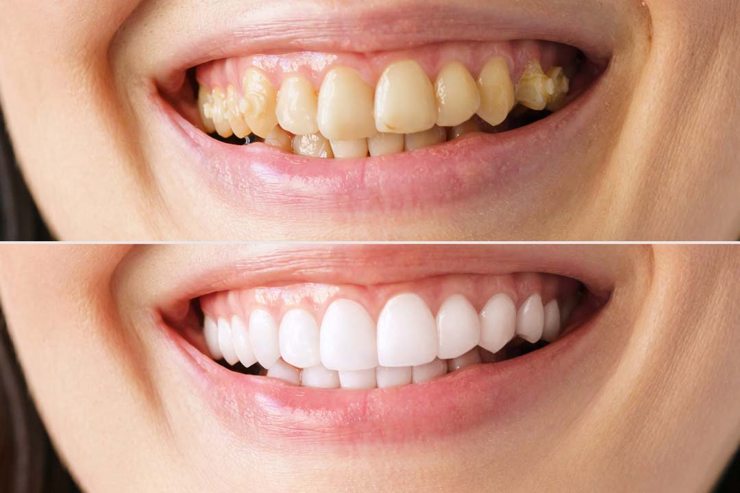 clareamento-dental_02