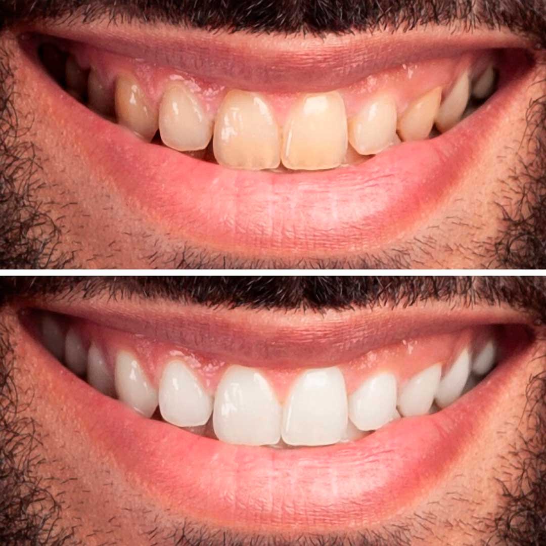 clareamento-dental_03