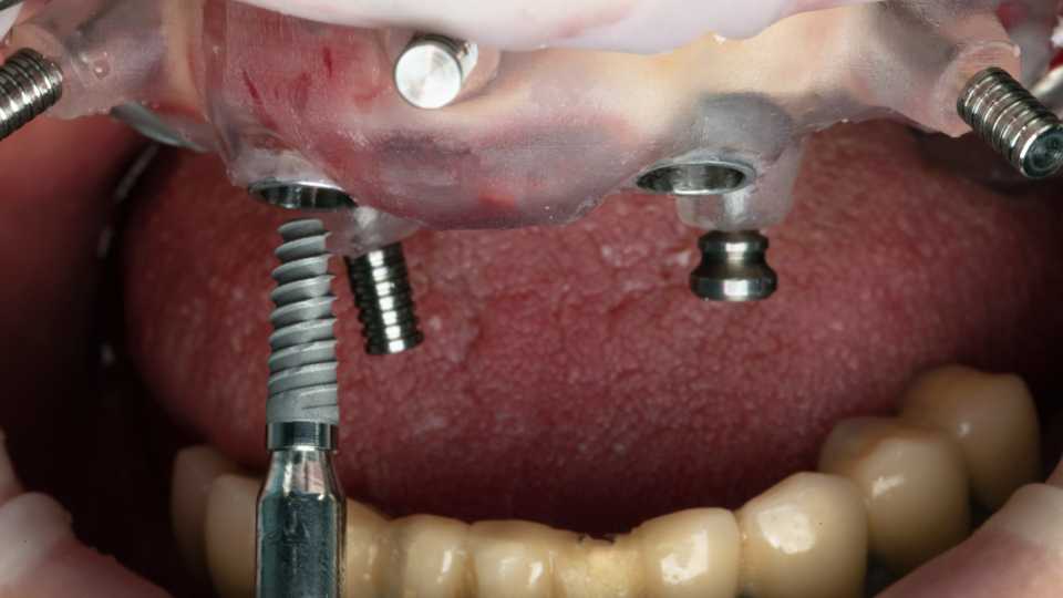 implante dentario